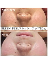 ビガク(BIGAKU)/毛穴の開きや皮脂分泌に◎