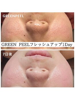 ビガク(BIGAKU)/毛穴の開きや皮脂分泌に◎