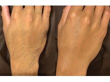 メンズ エステティック ヒーロー(men's esthetic HERO)/HERO　指甲WAX