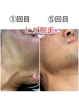 ブランニュー(brand new)/男性★ヒゲ脱毛