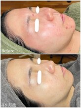 ちらちゅら/クリスティーナ＋毛穴洗浄