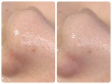 トータルビューティ ノイド(Noid)/毛穴洗浄　小鼻のみ