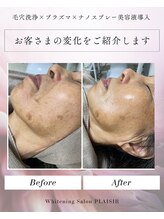 プレジール(PLAISIR)/毛穴洗浄×プラズマ×美容液導入