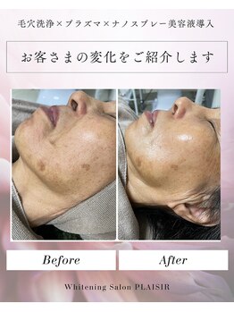 プレジール(PLAISIR)/毛穴洗浄×プラズマ×美容液導入
