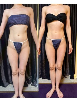 アスエ(ASUE)/エンダモロジー+サーモシェイプ