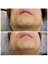 エン(EN)/ヒゲ脱毛 ビフォアアフター