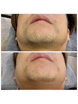 エン(EN)/ヒゲ脱毛 ビフォアアフター