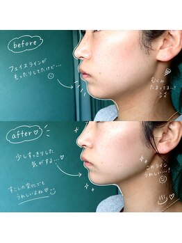 穂温の写真/よもぎ蒸しで代謝UP×プロの美技フェイシャル！毛穴を引き締め、むくみすっきり感動のフェイスライン！