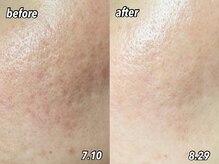 コム(comme39)/肌荒れは当店へ♪