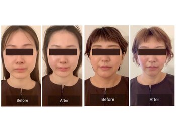 エミット(emit.)/小顔パルス美容鍼