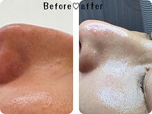 エムエー(MA)/ゾンビ・ハイドロジェリーパック