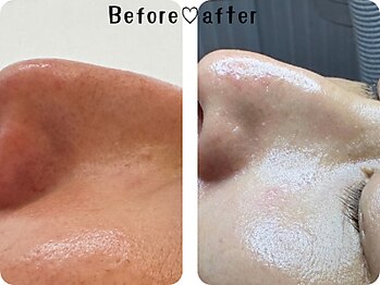 エムエー(MA)/ゾンビ・ハイドロジェリーパック