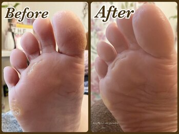 ビューティースパ(Beauty-Spa)/【タコ・ウオノメの角質除去】