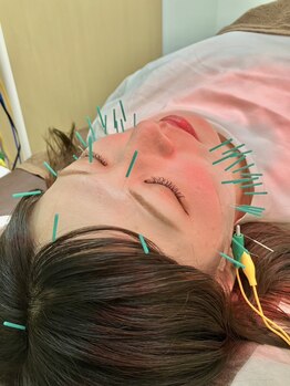 たけだ整体院 鍼灸院の写真/小顔&エイジングケアに◎ほうれい線/たるみ/エラ張り改善★リフトUP小顔へ♪【美容鍼+小顔矯正+ヘッド】
