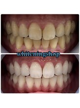 ホワイトニングショップ 和歌山店/Before&After美白ホワイトニング