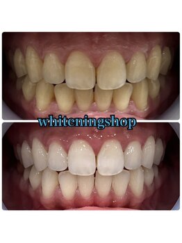 ホワイトニングショップ 和歌山店/Before&After美白ホワイトニング