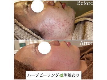 マドモアゼル 麻布十番/ハーブピーリング