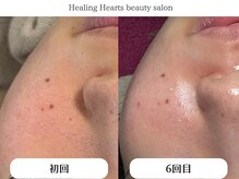 ヒーリングハーツ(Healing Hearts)