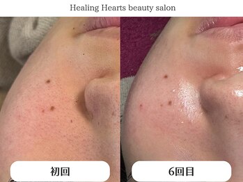 ヒーリングハーツ(Healing Hearts)