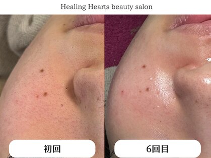 ヒーリングハーツ(Healing Hearts)の写真