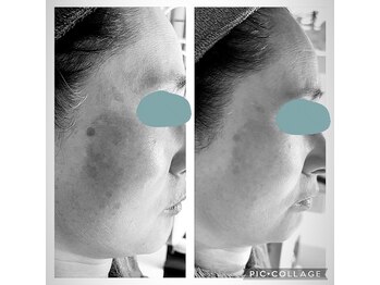 ローズマリー(rosemary)/1番人気【本格シミケア】