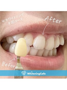 ホワイトニングカフェ 千葉店/ホワイトニングビフォーアフター