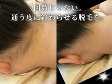 ダイヤ 名古屋中川区店(Daiya)/■うなじ脱毛/シェービング込み