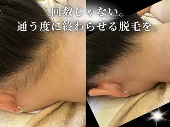 ダイヤ 名古屋中川区店(Daiya)/■うなじ脱毛/シェービング込み