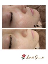 ラブグレイス(Lovegrace)/光フェイシャル