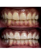 Grace Whitening Yokohama/40分照射＋水素吸引