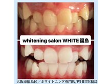 ホワイトニングサロン ホワイト(WHITE)/セルフホワイトニング/大阪/福島