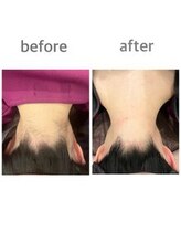 プリズム/女性襟足脱毛のビフォーアフター