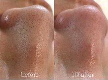 クレヴィー(Creviy)/韓国式3D毛穴洗浄1回