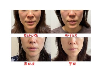 フラット柏(FLAT柏)/幹細胞を使った美容鍼・ダーマ鍼