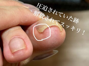 爪のいろは/痛みから解放！巻き爪補正＾＾