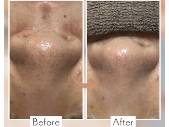 カピリナ(Kapilina)/毛穴汚れにピッタリ♪