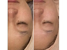 トータルエステティック ジョワイユ(JOYEUX)/★毛穴、くすみ、乾燥、肌改善★