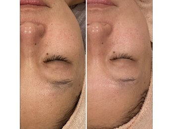 トータルエステティック ジョワイユ(JOYEUX)/★毛穴、くすみ、乾燥、肌改善★