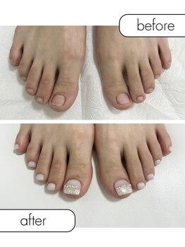 ピノ(pino)/◆フット深爪矯正◆