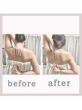 アリサナ(Arisana)/症例写真　肩甲骨はがし