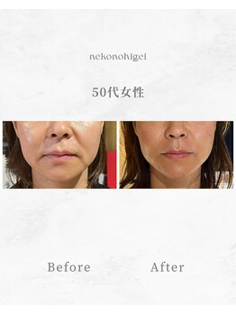 ねこのひげの写真/「老け顔」印象にサヨナラ！美容鍼でほうれい線・たるみ改善！憧れの小顔へ導きます◎