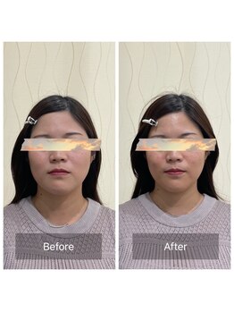 ハリ トモカ 南浦和サロン(HARI TOMOKA)/美容鍼