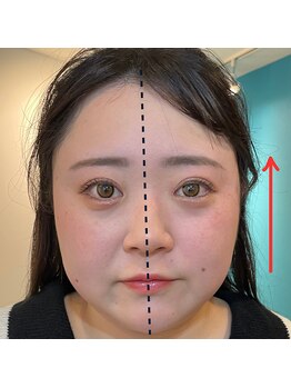 ネクスフィット(Nexfit)/小顔矯正フェイスリフトの効果