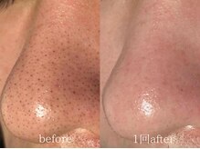 クレヴィー(Creviy)/韓国式3D毛穴洗浄1回