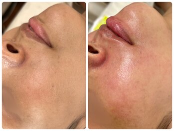 シシエル(CHICIEL)/フェイシャルワックス 顔脱毛