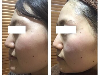 エヴァーグレース 河原町店/京都河原町の毛穴改善美肌サロン