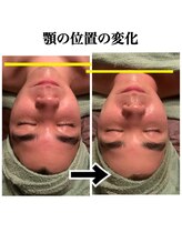 ルーチェ(LUCE)/小顔リフトUP/小顔矯正/筋膜