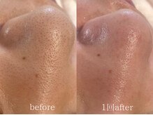 クレヴィー(Creviy)/韓国式3D毛穴洗浄1回