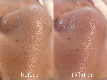 クレヴィー(Creviy)/韓国式3D毛穴洗浄1回