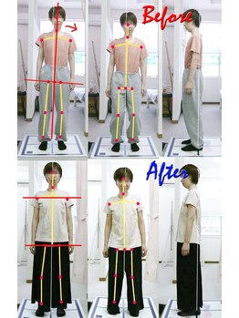 姫路なごみ整体院 なごみ鍼灸院/お尻と背中か首の痛み